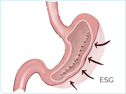 Endoscopic Sleeve Gastroplasty (ESG)