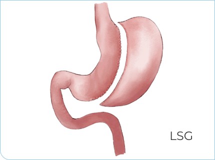 Laparoscopic Sleeve Gastroplasty (ESG)