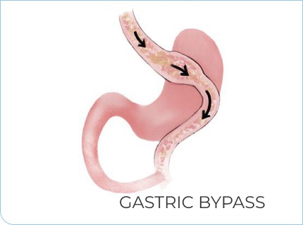 Gastric Bypass