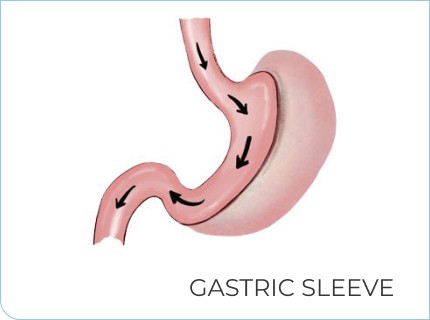 Endoscopic Sleeve Gastroplasty: The Wonders of Less Invasive Weight Loss Surgery