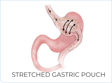 Stretched Gastric Pouch