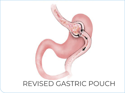 Revised Gastric Pouch
